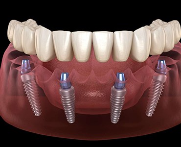 All-On-4 Dental İmplantlar